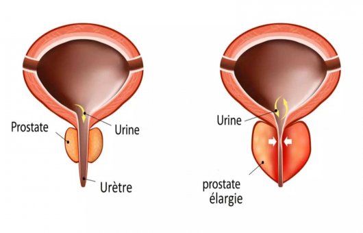 Adénome de la prostate