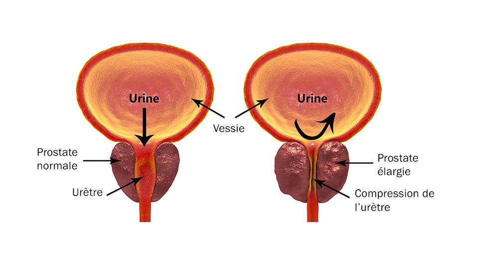 ecografía prostática transrectal ce fel de urină cu prostatita la bărbați