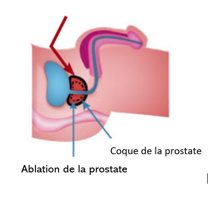 rabotage de la prostate 'effets secondaires prostatita inversa